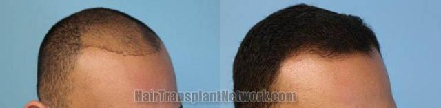 Hair transplantation surgery before and after photos