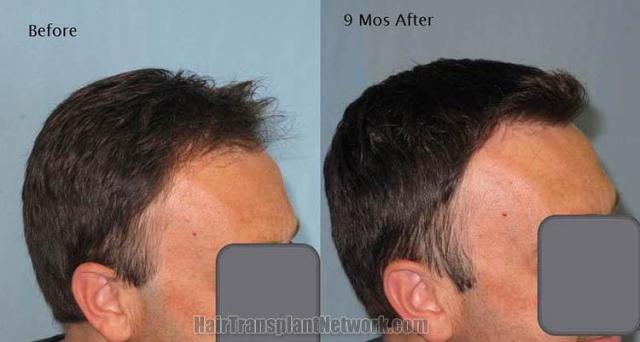 Hair transplantation surgery before and after pictures