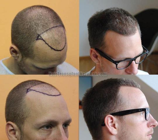 Hair transplantation surgery before and after images