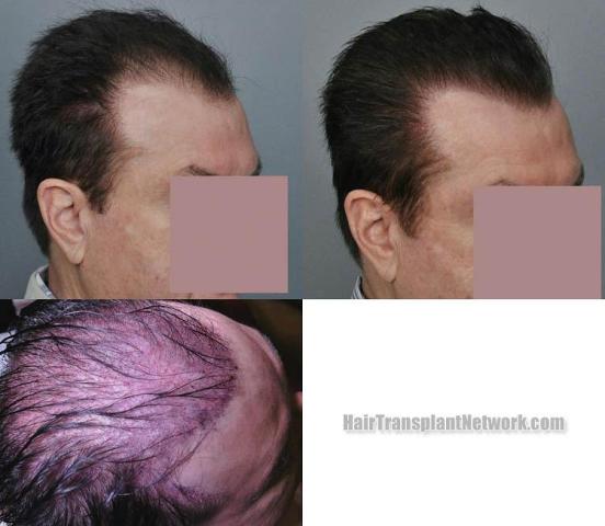 Hair transplantation surgery before and after images