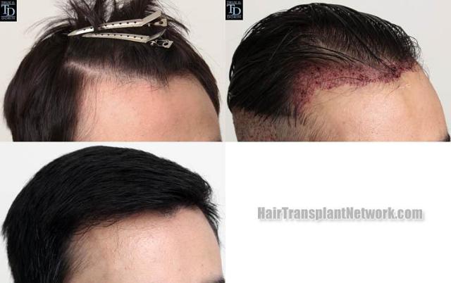 Hair transplantation surgery before and after images