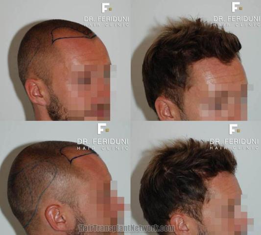 Hair restoration procedure before and after pictures