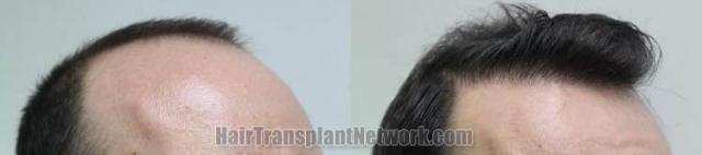 Hair transplantation surgery before and after images