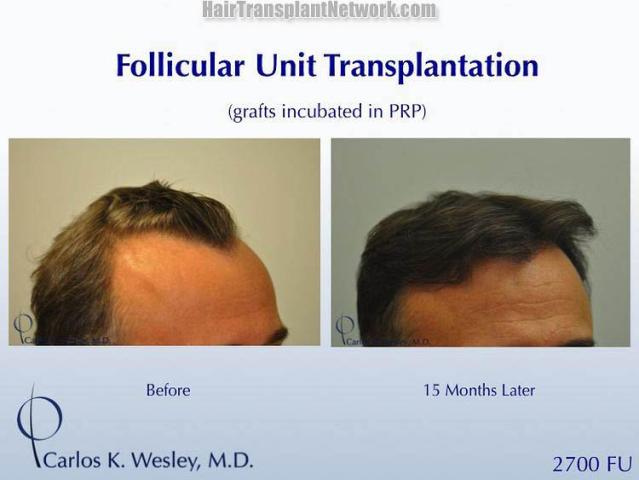 Hair transplantation surgery before and after photos