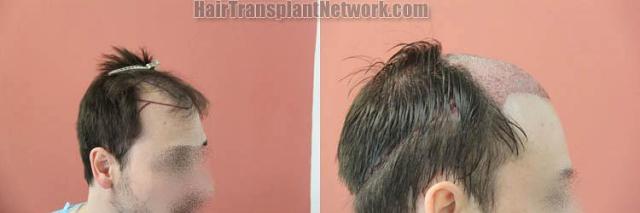 Hair transplantation surgery before and after pictures