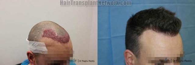 Hair restoration procedure before and after pictures