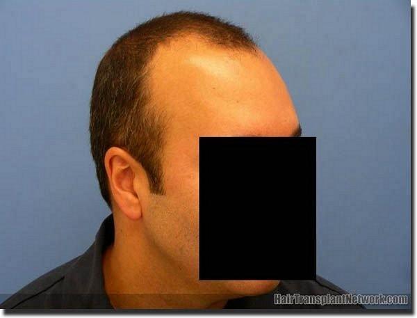 Hair restoration procedure results