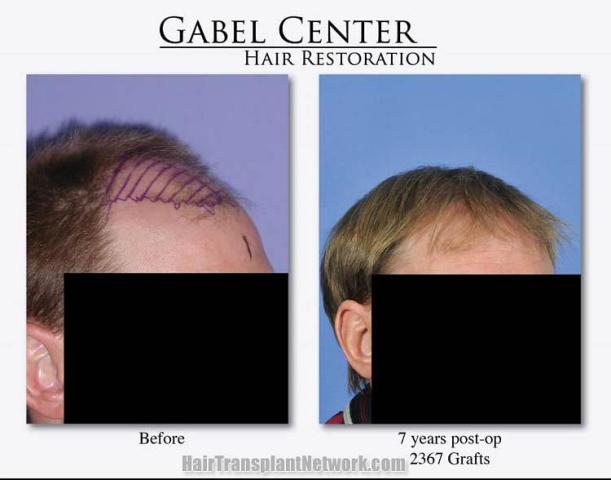 Hair restoration surgery before and after images