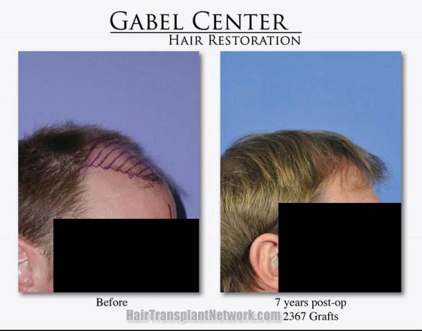 Hair restoration procedure before and after pictures