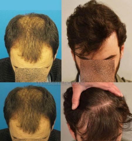 Hair transplantation surgery before and after images