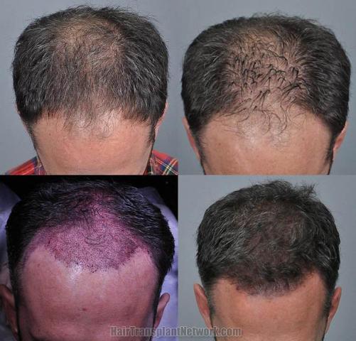 Hair transplantation surgery before and after pictures