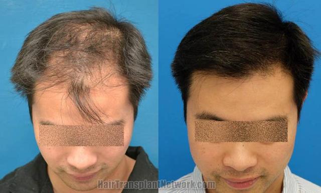 Before and after hair transplantation result photographs