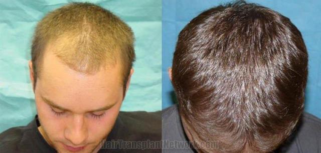 Hair restoration procedure photos - Top view 