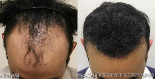 Top view - Before and after surgical hair replacement