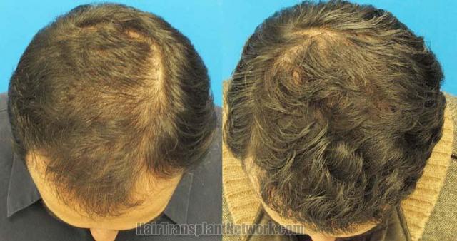 Hair transplantation surgery before and after photos