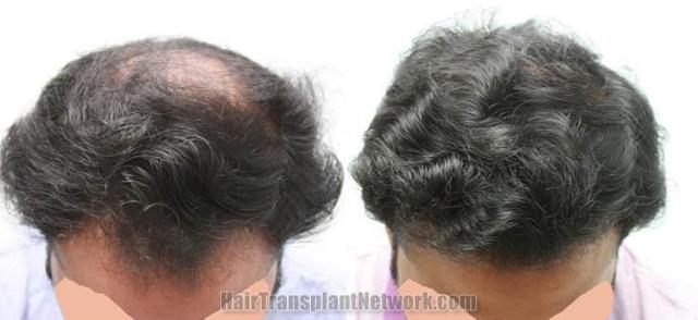 Top view before and after hair restoration results