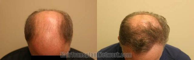 Hair transplantation surgery before and after images