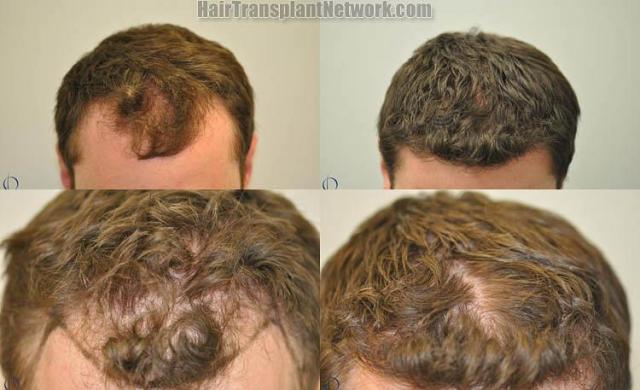 Hair restoration procedure before and after results