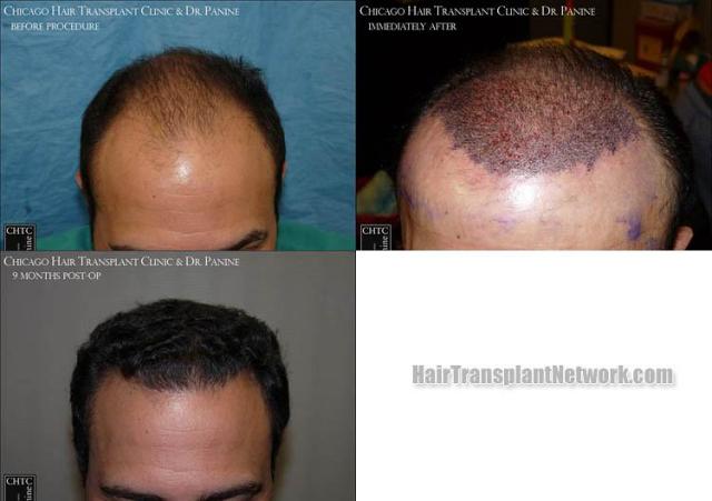 Hair transplantation surgery before and after photos