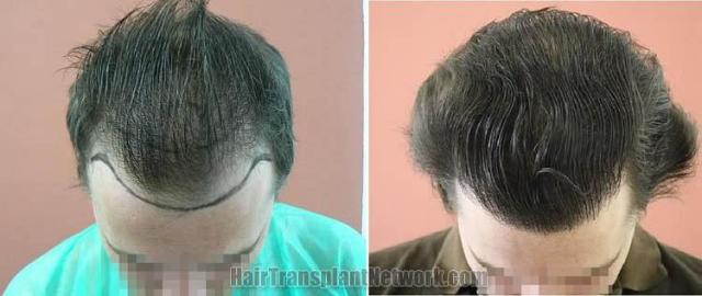 Hair transplantation surgery before and after pictures