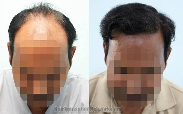 Top view before and after hair restoration results