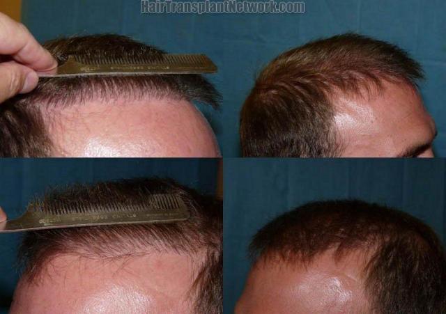 Hair replacement surgery before and after pictures