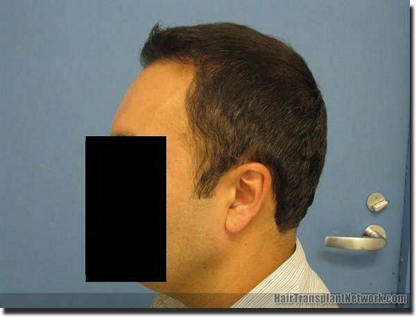 Hair restoration procedure results