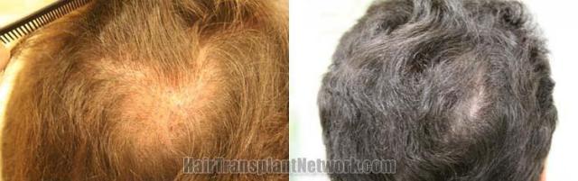 Back view before and after hair transplantation photos