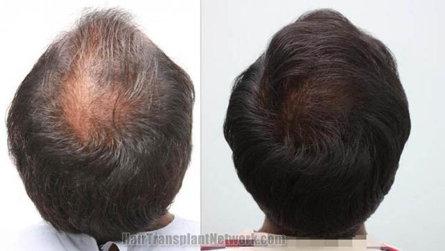 Hair transplantation surgery before and after pictures