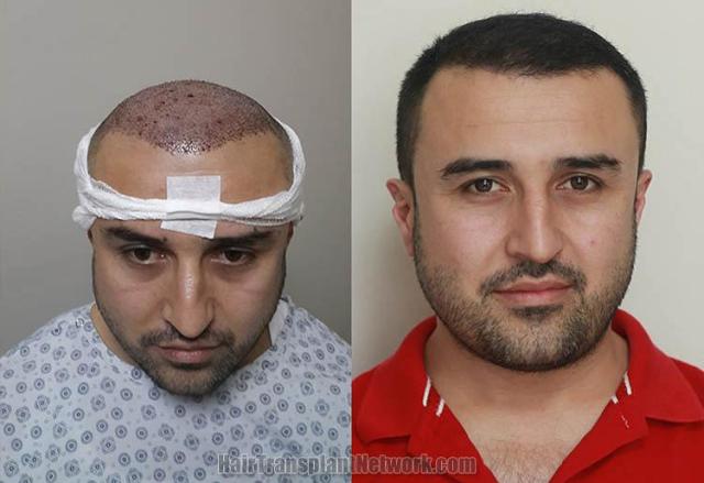 Front view - Before and after hair transplant surgery result pictures