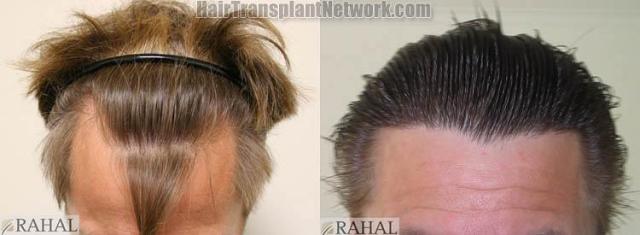 Hair transplantation surgery before and after pictures