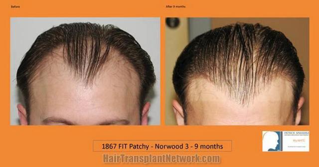 Before and after hair transplant procedure images