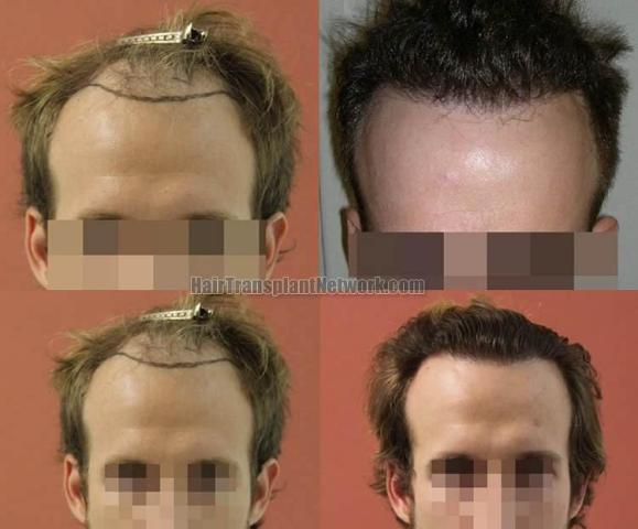 Hair transplantation surgery before and after images