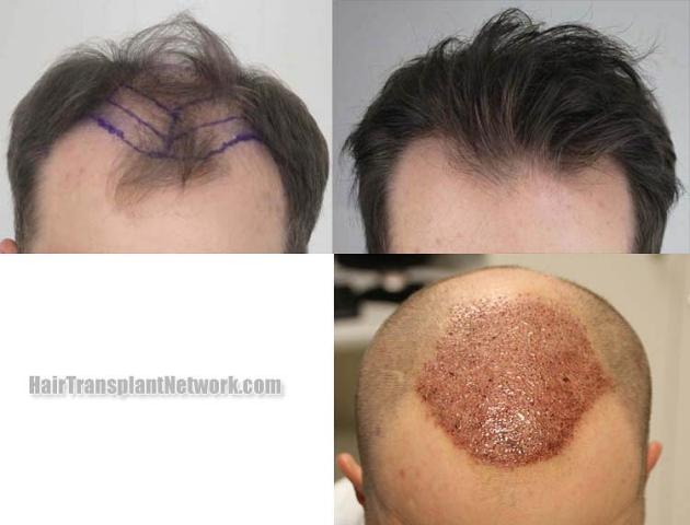 Hair restoration procedure before and after results