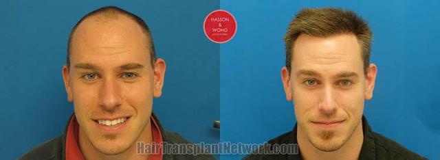 Hair restoration procedure before and after results