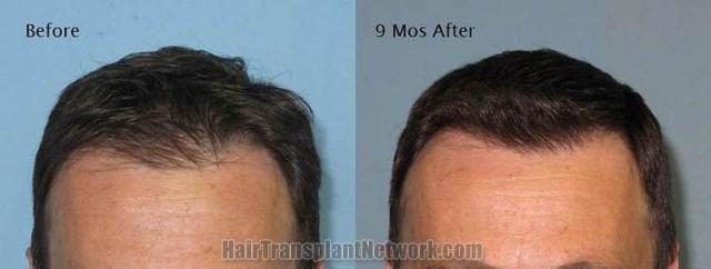 Hair restoration procedure before and after results