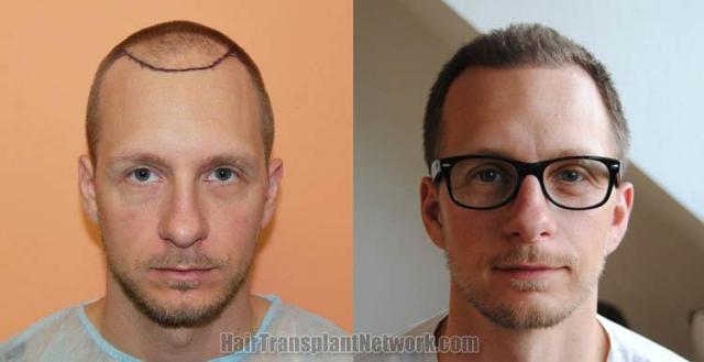 Hair restoration procedure before and after results