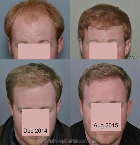 Hair restoration procedure before and after results