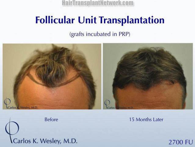 Front view - Before and after hair transplant surgery