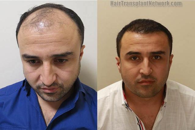 Front view - Before and after hair transplant surgery result images