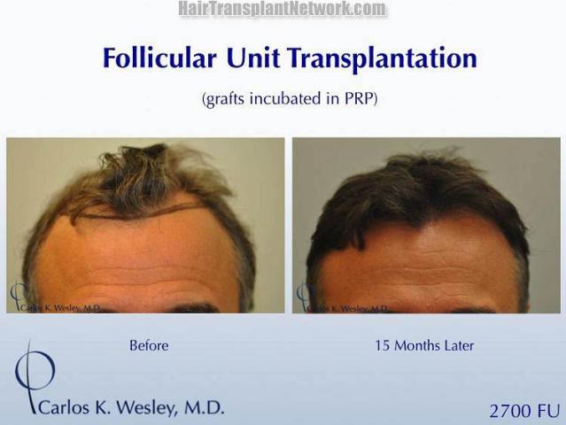 Before and after hair transplant procedure images