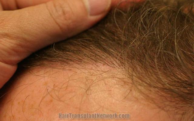 Hair transplantation surgery before and after pictures