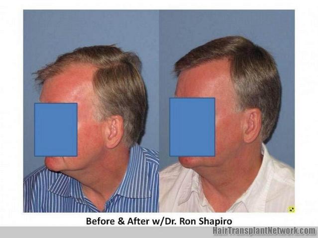 Left side hair transplant results