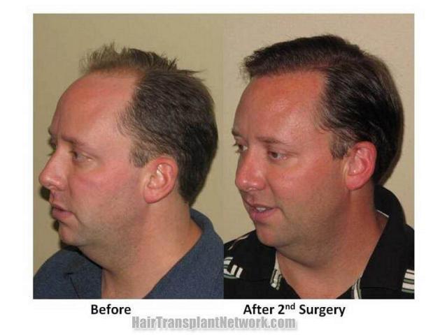 Left view - Before and after hair transplant