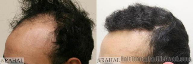 Hair restoration procedure before and after pictures