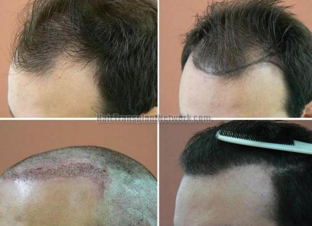 Hair transplantation surgery before and after photos