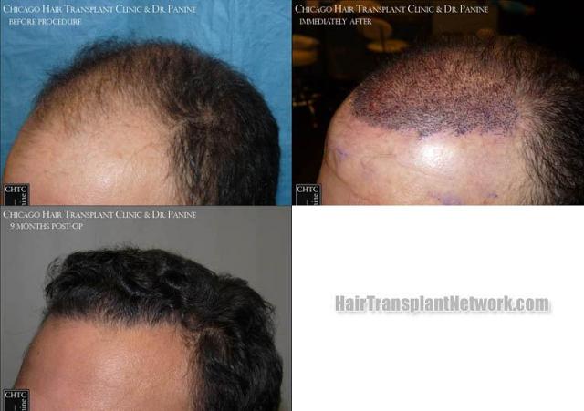 Hair transplantation surgery before and after pictures