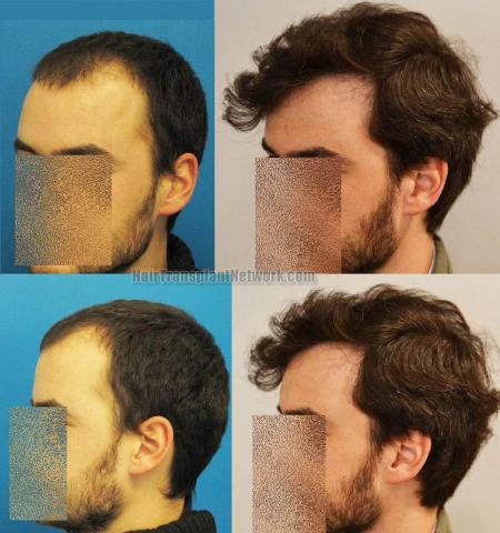 Hair restoration procedure before and after results