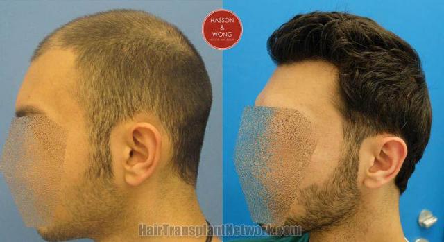 Hair transplantation surgery before and after pictures