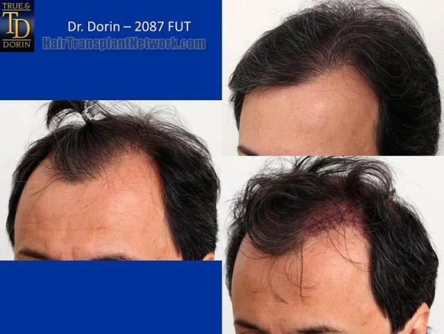 Hair transplantation surgery before and after pictures